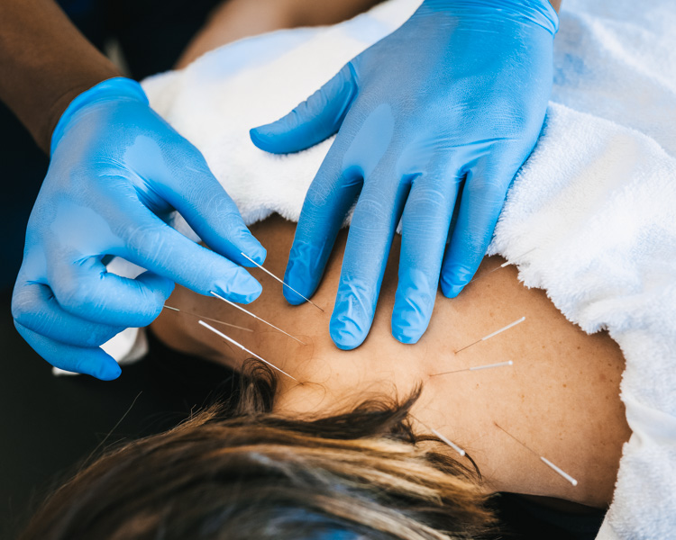 Dry Needling